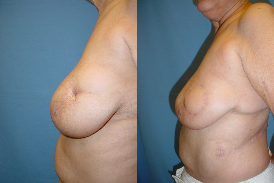 Breast Reconstruction Before & After