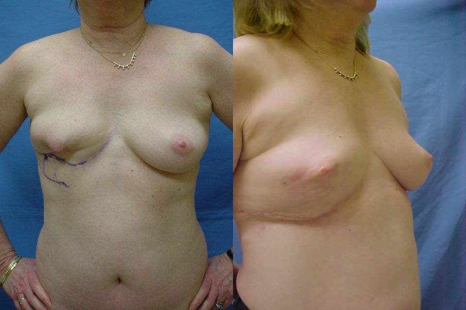 Breast Reconstruction Before & After