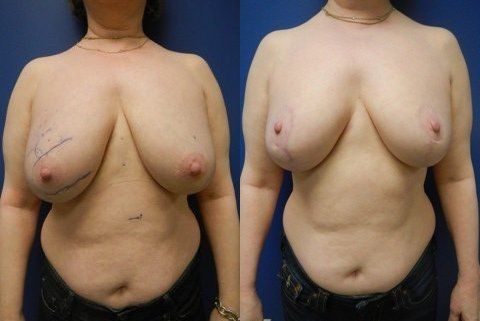 Breast Reconstruction Before & After