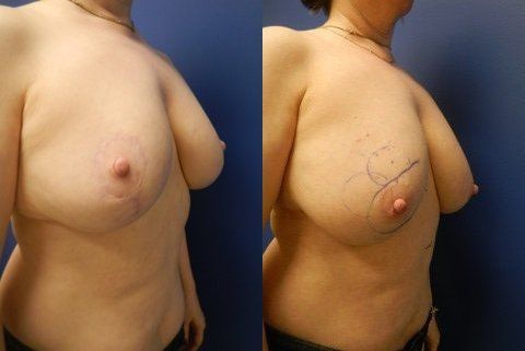 Breast Reconstruction Before & After