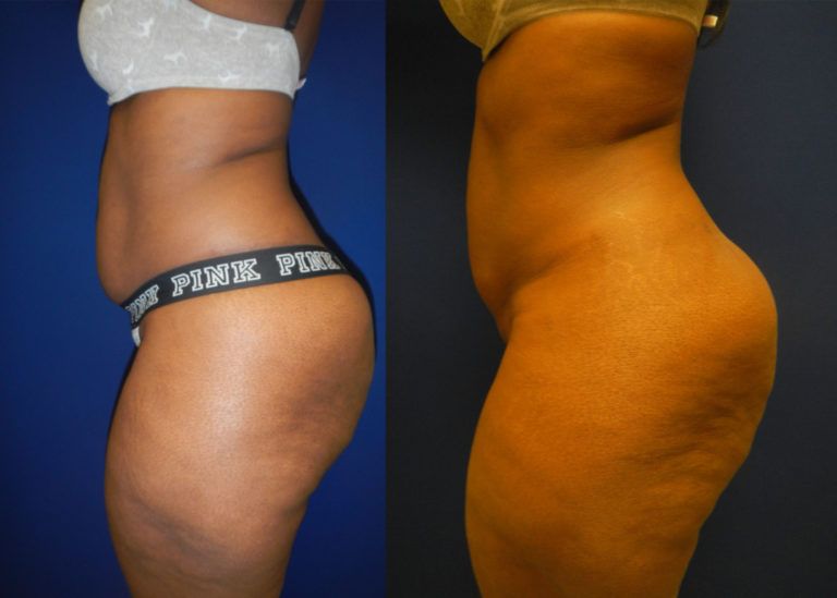 Liposuction Before & After