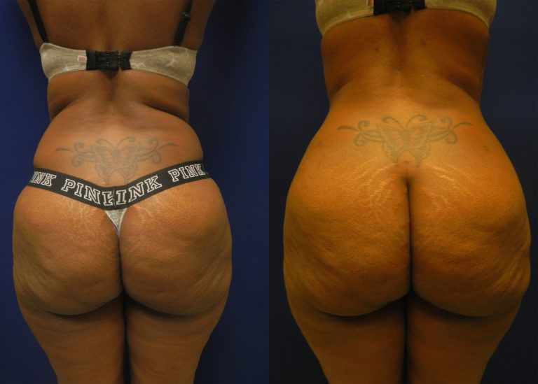 Liposuction Before & After