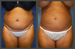 Liposuction Before & After