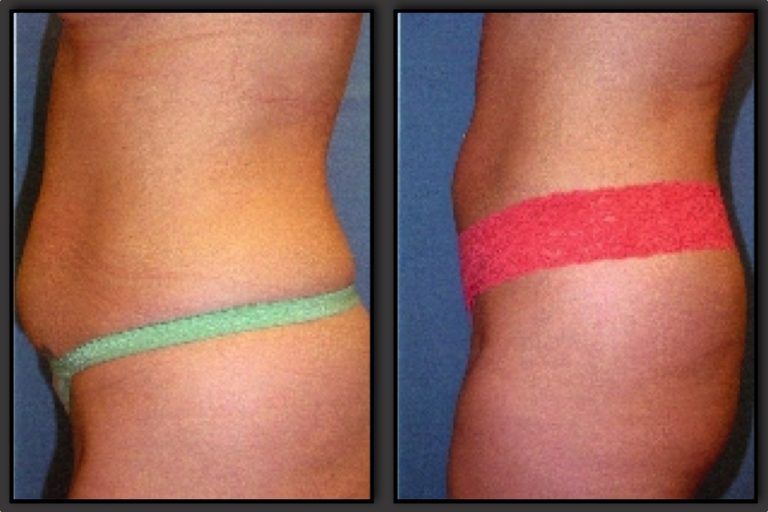 Liposuction Before & After
