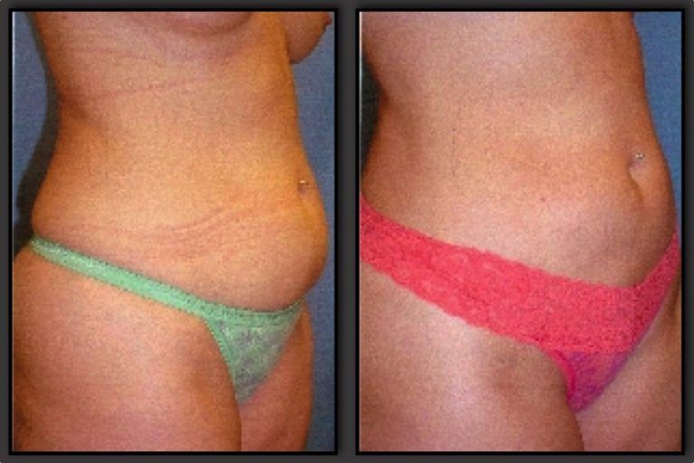 Liposuction Before & After