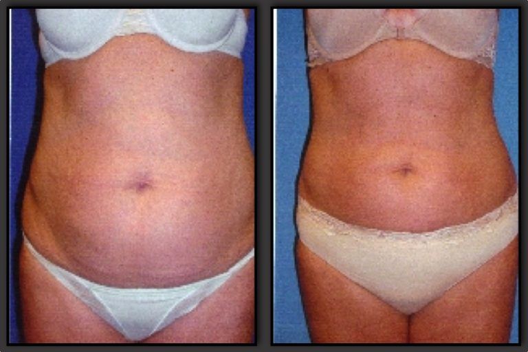Liposuction Before & After