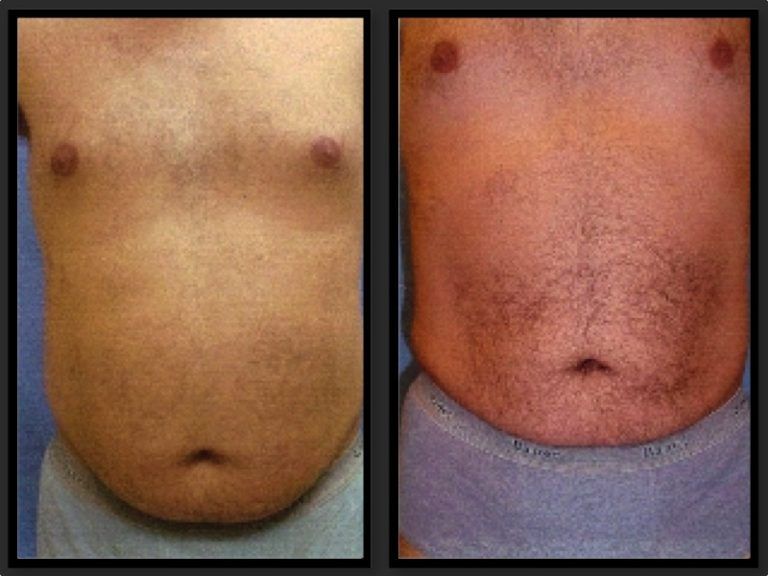 Liposuction Before & After