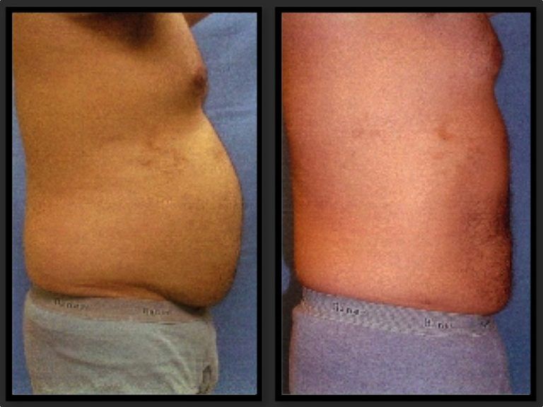 Liposuction Before & After