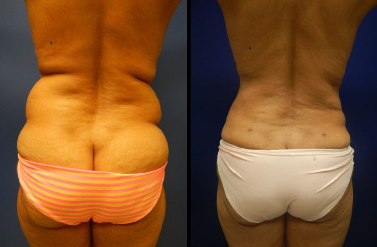 Liposuction Before & After