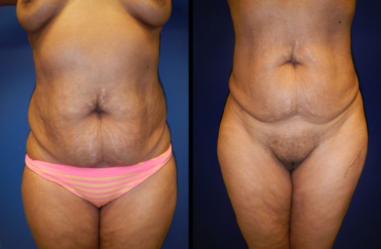 Liposuction Before & After