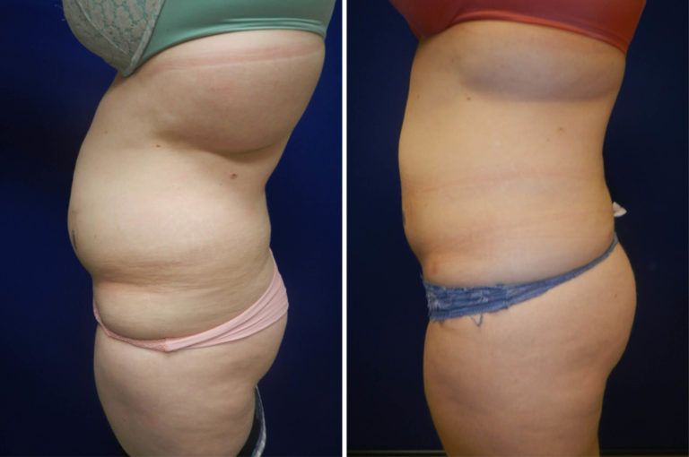 Liposuction Before & After