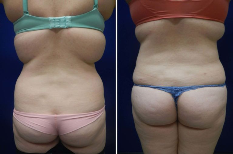 Liposuction Before & After