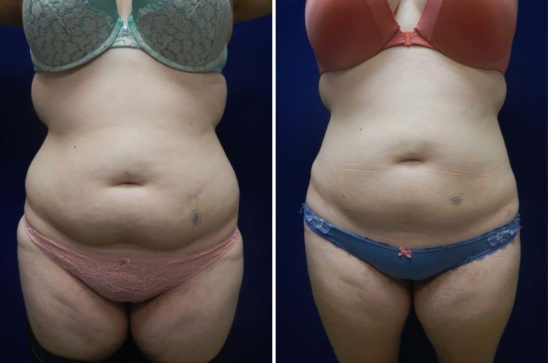Liposuction Before & After