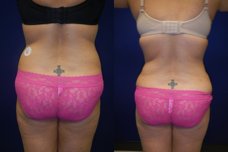 Liposuction Before & After