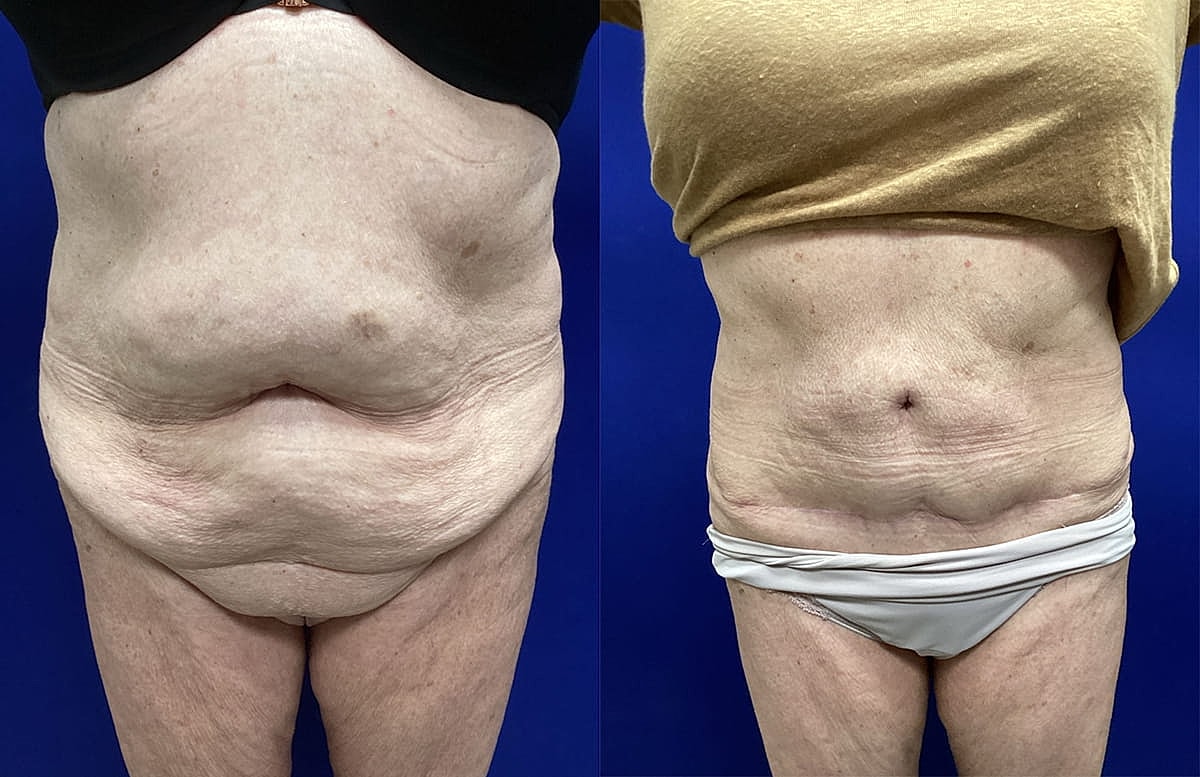 Before and after body contouring results.