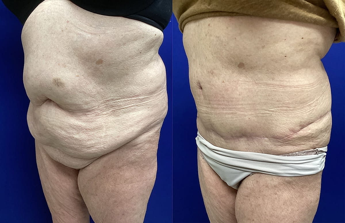 Before and after body skin texture comparison.