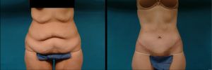 Tummy Tuck Before & After