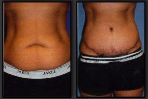 Tummy Tuck Before & After