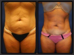 Tummy Tuck Before & After