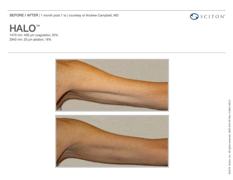 Sciton Joule Procedures  Before & After