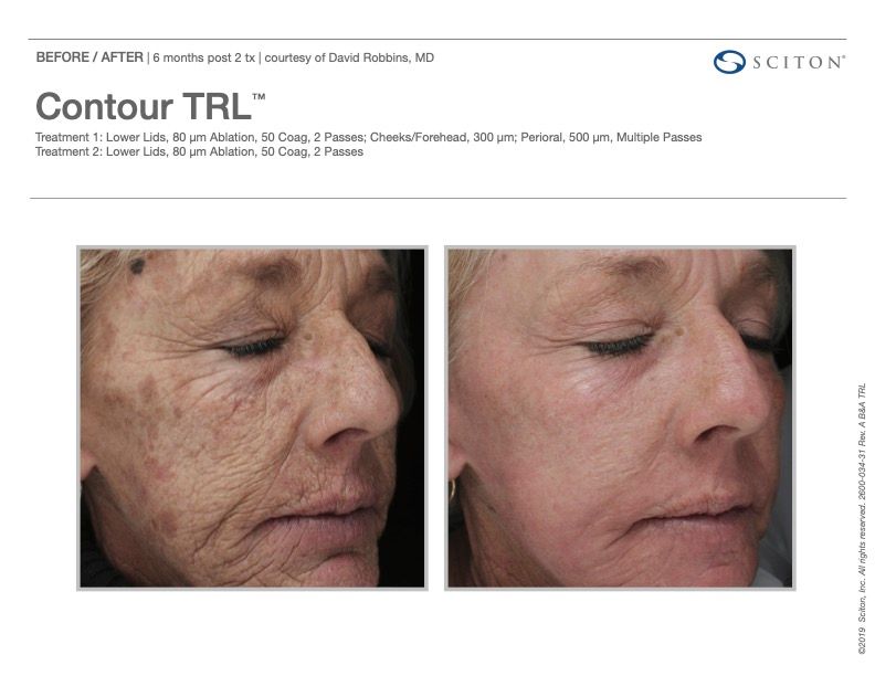 Sciton Joule Procedures  Before & After