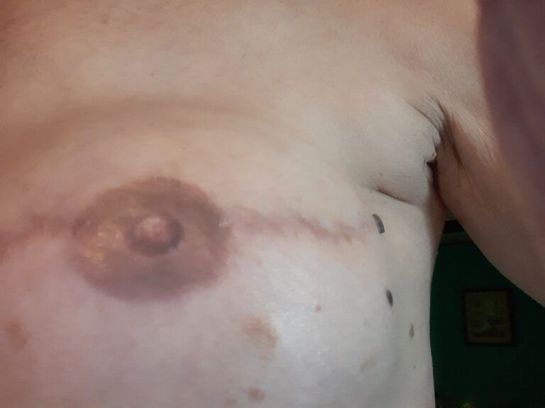 Nipple Tattooing Before & After