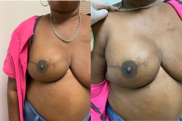 Nipple Tattooing Before & After