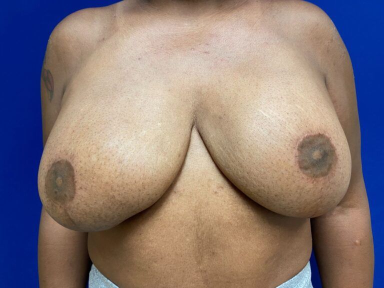 Nipple Tattooing Before & After