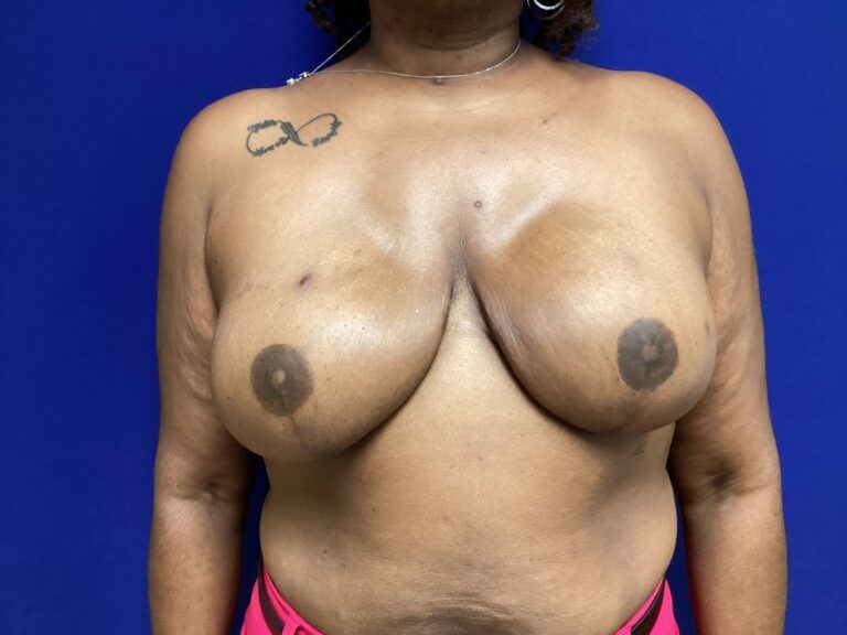 Nipple Tattooing Before & After