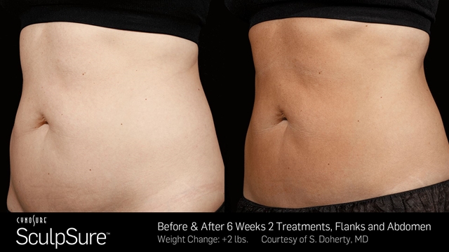 SculpSure for Fat Reduction in Memphis
