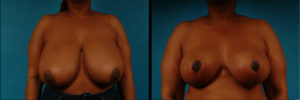 Dr. Kath breast reduction
