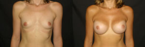 breast implants memphis
