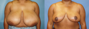 Chandler breast reduction
