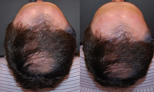 memphis plastic surgery male hair loss neograft