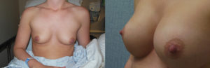 breast implants memphis