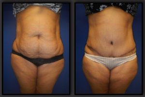 Before and After Abdominoplasty