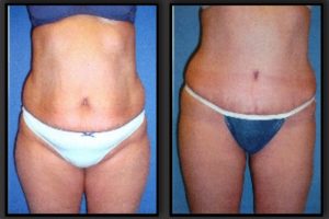 Before and After Abdominoplasty