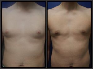 Before and After Male Breast Reduction