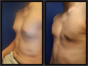 Before and After Male Breast Reduction