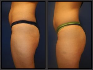 Brazilian Butt Lifts | Plastic Surgery Group of Memphis