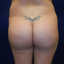 Brazilian Butt Lifts | Plastic Surgery Group of Memphis