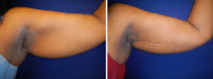 Tavin Arm Lift Before and After