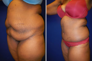 tummy tuck memphis - abdominoplasty | Memphis Plastic Surgery