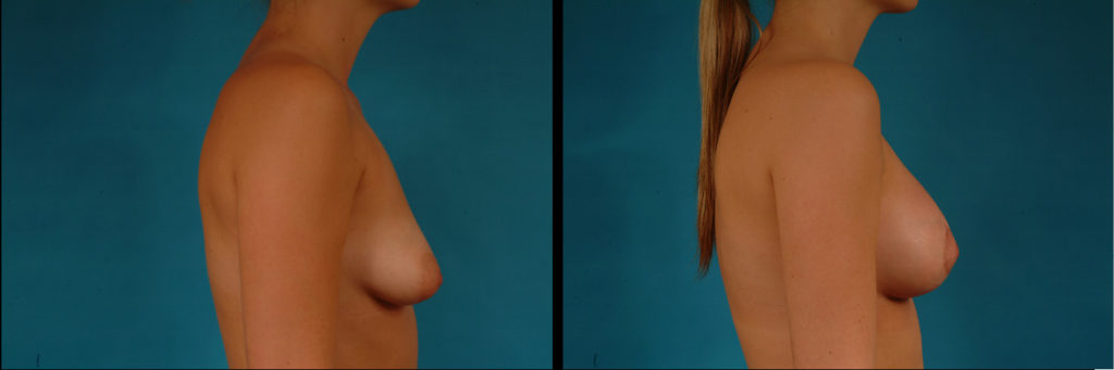 Augmentation Mastopexy Before and After