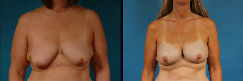 Bilateral Breast Reconstruction Before and After