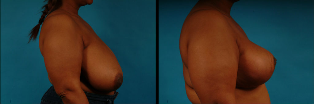 Breast Reduction Before and After