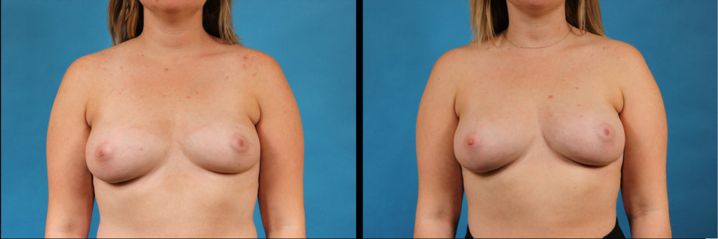Fat Grafting Before and After