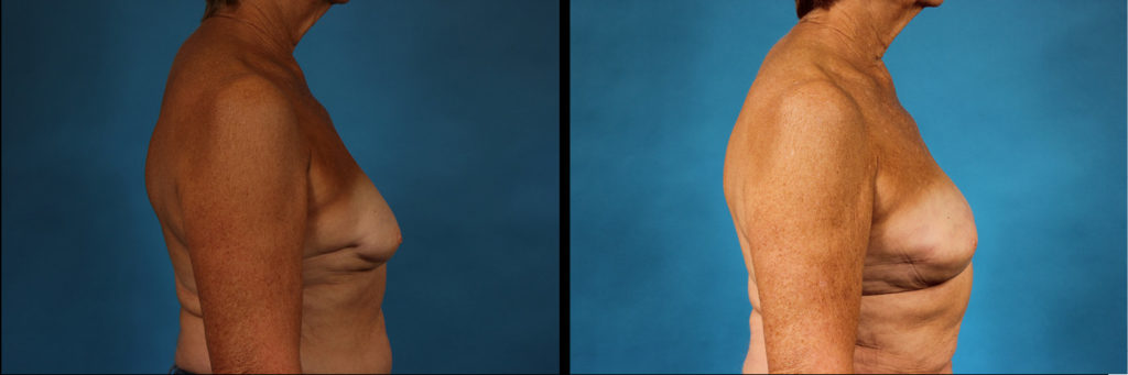 Fat Grafting Before and After