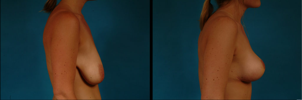 Mastopexy Before and After