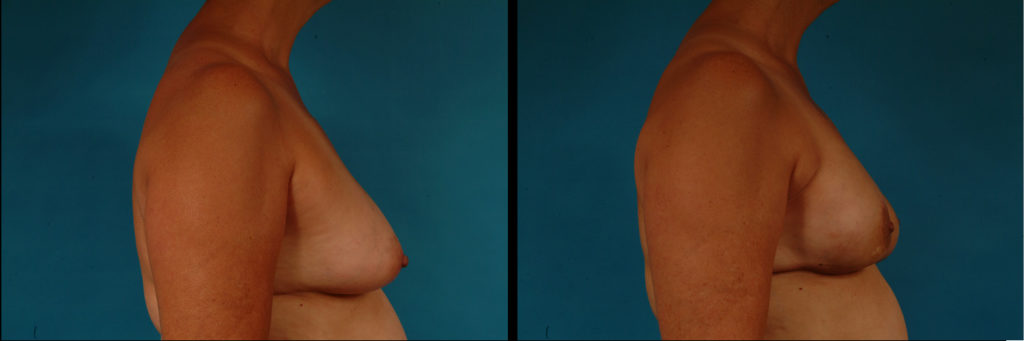 Unilateral Breast Reconstruction Before and After